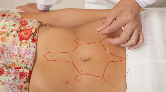 طب سوزنی لاغری
